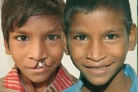 Ranjit, 12 Jahre vor und nach seiner Cleft- Operation